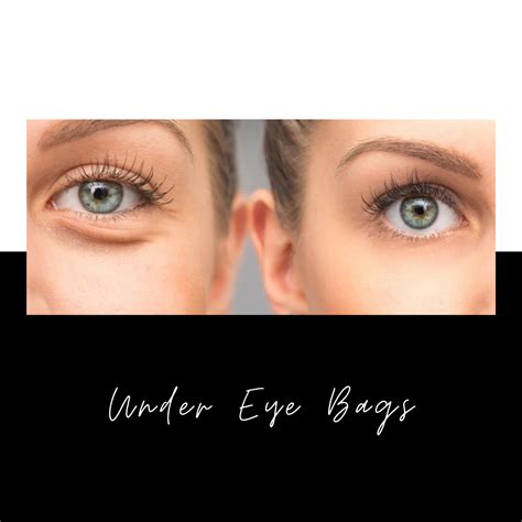 Bags Under Eyes Causes Treatments And Solutions