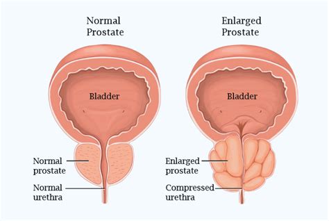 Prostate Issues Prostate Cymru
