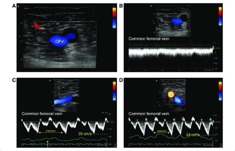 A Two Dimensional Ultrasound Image Of Common Femoral Vein Cfv And