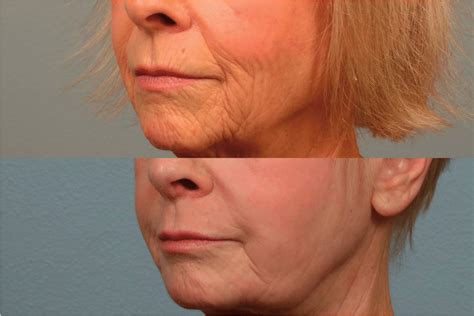 Above 73 Year Old Woman Before Surgery Below 6 Months Post Laser