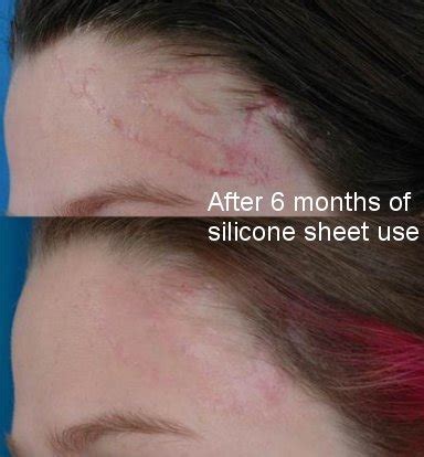 Silicone Sheet 75 X 45 Mm Keloid And Hypertrophic Scars