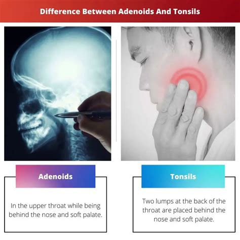 Adenoids Vs Tonsils Difference And Comparison