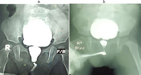 Figure 1 From Early Outcome Of Cold Knife Ablation And Diathermy Fulguration Of Posterior