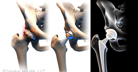 Direct Anterior Approach Hip Replacement Adam Watson Orthopaedic Surgeon