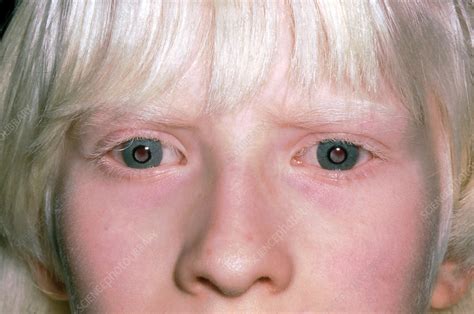 Ocular Albinism Stock Image C0365795 Science Photo Library