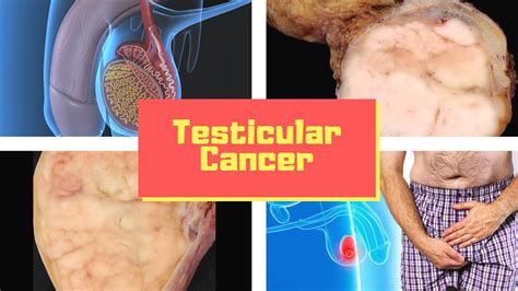 Some can be as small as a pea or marble, but some can grow larger. Testicular cancer Symptoms - Causes, Pictures, Signs and ...