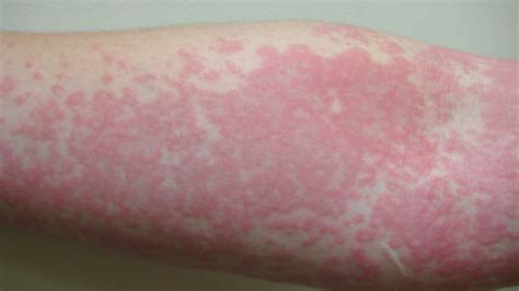 Hives Rash Serious Conditions That Rashes And Hives Can Indicate