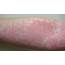 Coronavirus Skin Rash Can Be Only COVID 19 Symptom And Should 