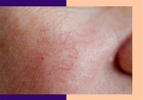 Broken Capillaries 101 What Are They And How Can We Treat Them