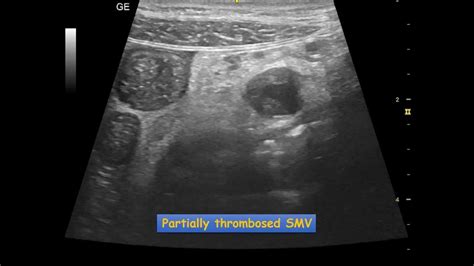 Mesenteric Vascular Occlusion Ultrasound Case Git Youtube
