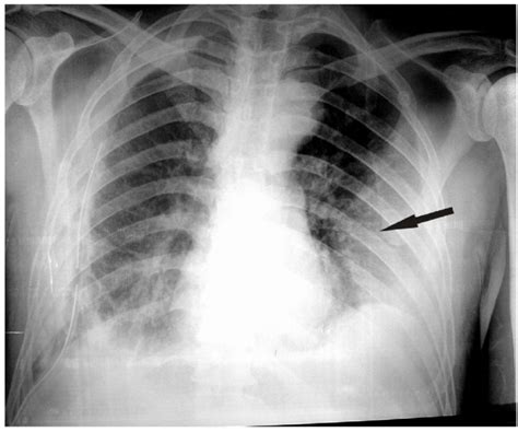 Preoperative Chest X Ray Showing A Right Sided Pleural Effusion And An The Best Porn Website