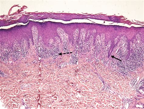 Histopathology Of Lichen Planus Black Solid Arrow Showing A Saw Tooth