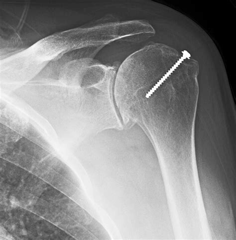 Uw Shoulder And Elbow Academy How Bad Is The Shoulder Arthritis On X Ray