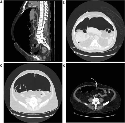 Abdominal Ct Scan A Sagittal View Showing The Presence Of Air In The