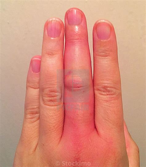 Swollen And Infected Finger From Insect Bite License Download Or Print For £3100 Photos