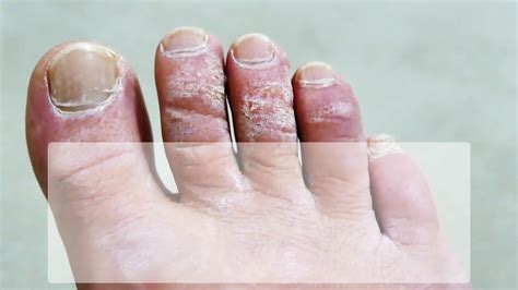 Fungal Foot Infections Youtube