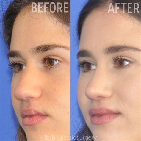 Dr Dhir Facial Plastics On Instagram Here Is A Before And After Of
