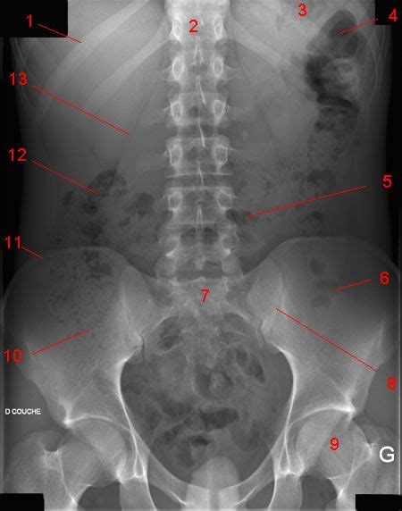 Abdominal X Ray Radiography Abdominal Aorta Radiology Student