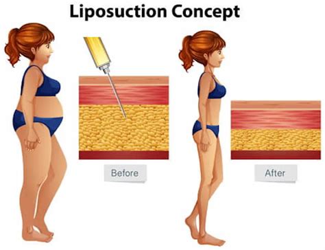 A Comprehensive Guide To Liposuction Recovery By Dr Alton Ingram In