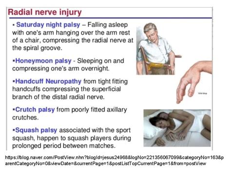 Radial Nerve Palsy Clinical Features And Diagnosis