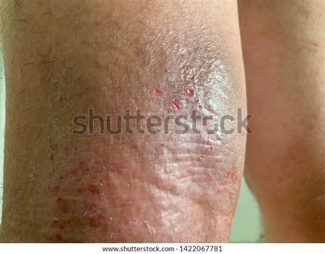 Back Knees Atopic Eczema Causes Areas Stock Photo 1422067781 Shutterstock