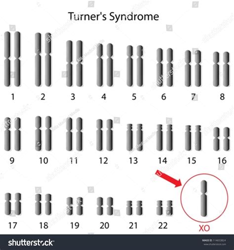Monosomía X síndrome de Turner vector de stock libre de regalías