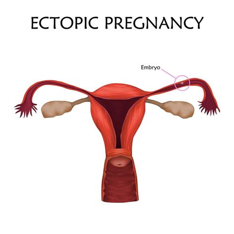 Life After Ectopic Pregnancy