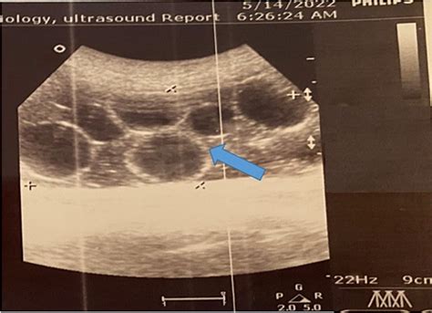 Ultrasonography Image Of Hydatid Cyst With Its Daughter Cysts