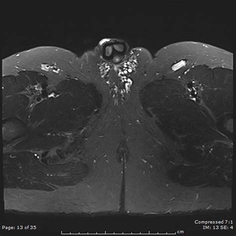 Penile Mondor Disease Dorsal Penile Vein Thrombophlebitis Image