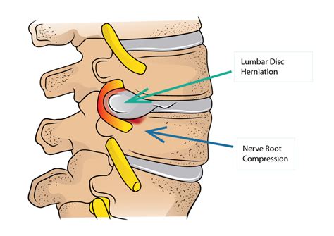 We know what goes into our remedies, so we know what you'll get out of them. Lumbar Disc Herniation and Sciatica | Dr Yu Chao Lee