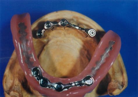 Quality dentures handcrafted right in your local office. Basale Implantate