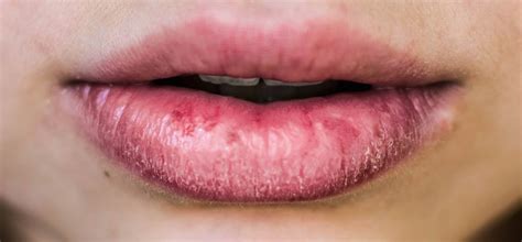 Lip Eczema Cause Symptoms On Baby How To Treat Cure Home Remedies