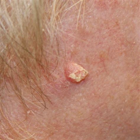 Can Skin Cancer Look Like An Ingrown Hair Dane101