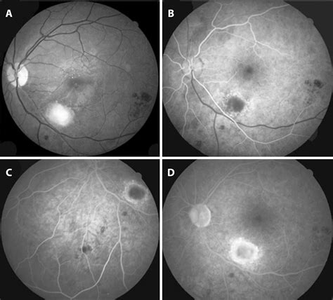Scielo Brasil Combined Branch Retinal Vein And Artery Occlusion In