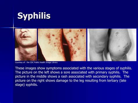 Syphilis Syphilis Symptoms Treatment Is It Curable And Diagnosis
