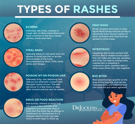 Sciarpa Scongelare Scongelare Scongelare Reazione Types Of Rashes On