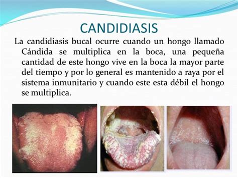 Candidiasis Bucal Causas Síntomas Y Tratamiento Bezzia