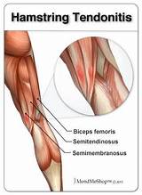 Pictures of Medical Treatment For Tendonitis