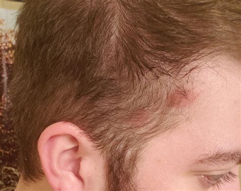 So I Have A Rash On The Rightside Of My Headscalp Ive Had It For