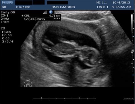 First Ultrasound 8 Weeks What To Expect Wjoy