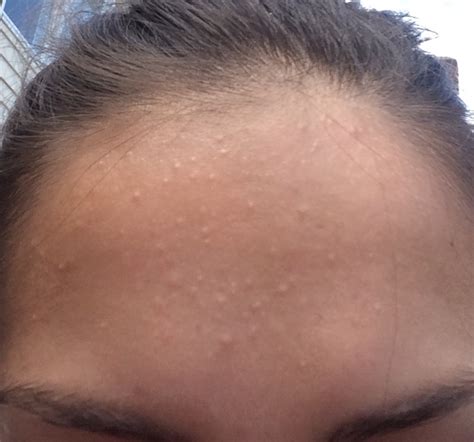 Small Bumps On Forehead General Acne Discussion By A1842l Acne