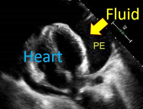 What Is Pericardial Effusion All About Heart And Blood Vessels