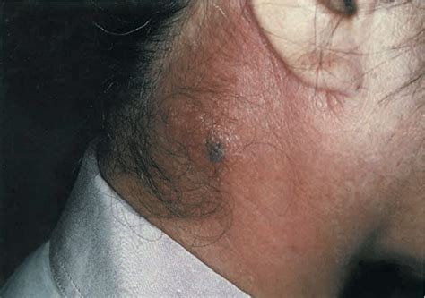 Figure 1 From A Case Of Lyme Disease With Parotitis Semantic Scholar