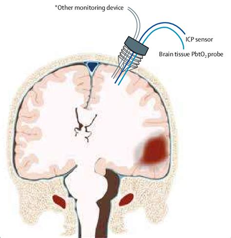 Multimodal Monitoring Of Brain Physiology After Traumatic Brain Injury