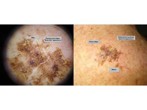 Dermpath Made Simple Neoplastic Seborrhoeic Keratoses And Variants