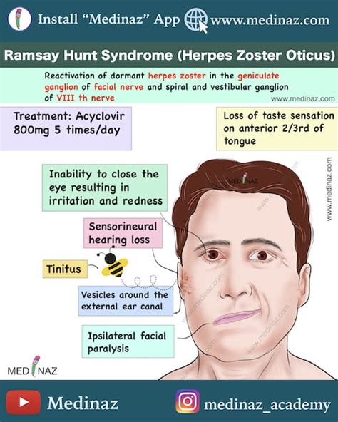 Ramsay Hunt Syndrome Hy Medicine Notes