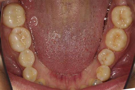 Replacing Heavily Damaged Teeth By Third Molar Autotransplantation With
