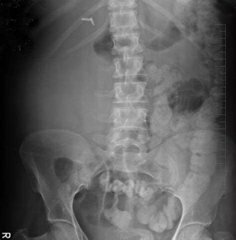 Digital X Ray Kub Showed A Large Soft Tissue Density In Right Lumbar
