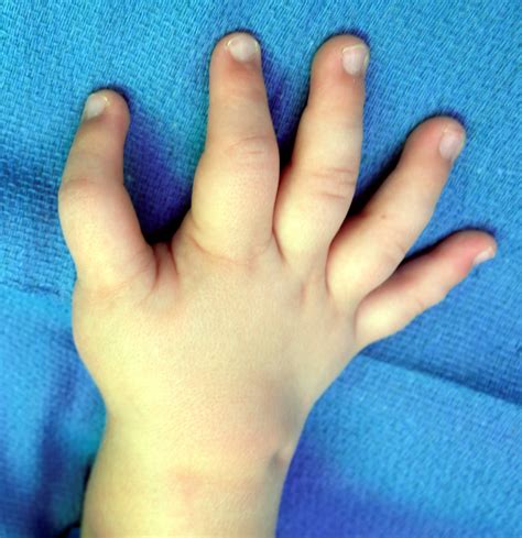 Congenital Hand And Arm Differences