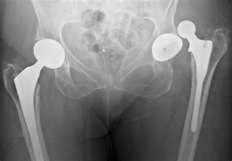 Dislocated Hip Replacement X Ray Photograph By Du Cane Medical Imaging Ltd